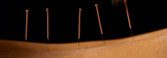 Chiropractic Germantown MD Dry Needling On Back